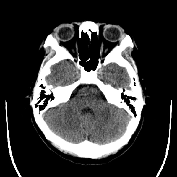 Calvarial osteoma (Radiopaedia 36520-38079 Axial non-contrast 15).jpg