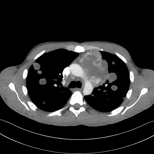 File:Cannonball metastases - testicular choriocarcinoma (Radiopaedia 84510-99891 B 47).jpg
