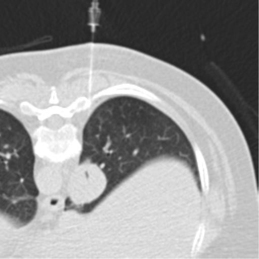 File:Carcinoid tumor - lung (Radiopaedia 44814-48644 Axial lung window 92).png