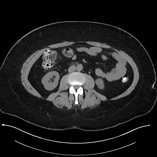 Carcinoid tumor - terminal ileum (Radiopaedia 60931-68740 Axial non-contrast 57).jpg