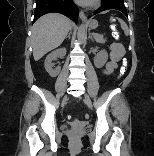 Carcinoid tumor - terminal ileum (Radiopaedia 60931-68740 Coronal non-contrast 64).jpg