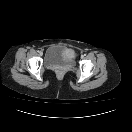Carcinoma colon - hepatic flexure (Radiopaedia 19461-19493 A 122).jpg
