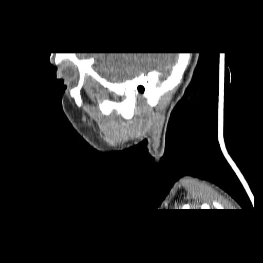 Carcinoma of the maxillary antrum (Radiopaedia 53805-59888 Sagittal C+ delayed 152).jpg