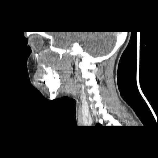 Carcinoma of the maxillary antrum (Radiopaedia 53805-59888 Sagittal C+ delayed 69).jpg