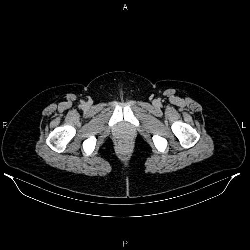 File:Carcinoma of uterine cervix (Radiopaedia 85861-101700 Axial C+ delayed 95).jpg