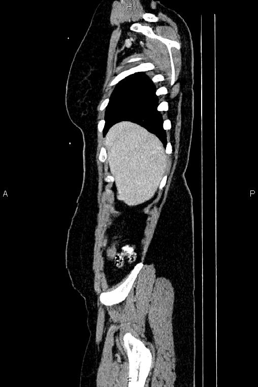 Carcinoma of uterine cervix (Radiopaedia 85861-101700 D 5).jpg