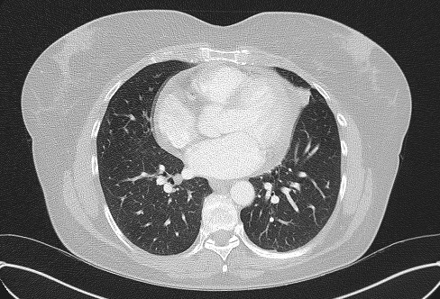 Cardiac sarcoidosis (Radiopaedia 74548-85534 Axial lung window 52).jpg