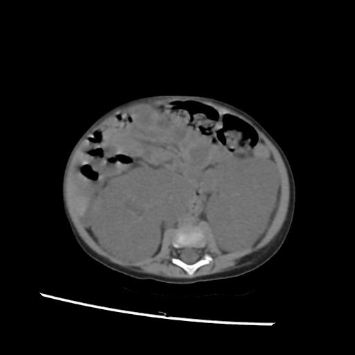 File:Caroli disease with autosomal recessive polycystic kidney disease (ARPKD) (Radiopaedia 89651-106703 Axial non-contrast 34).jpg