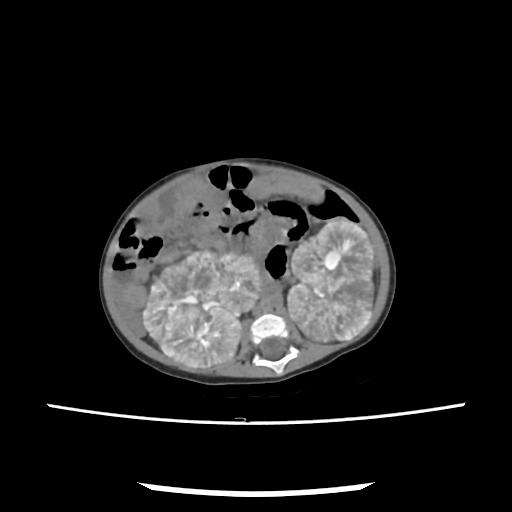 Caroli disease with autosomal recessive polycystic kidney disease (ARPKD) (Radiopaedia 89651-106703 E 125).jpg