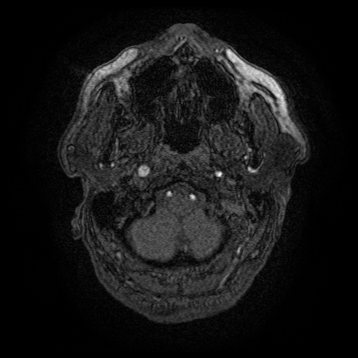 Carotid arterial dissection with acute cerebral infarction (Radiopaedia 26636-26784 MRA 166).jpg