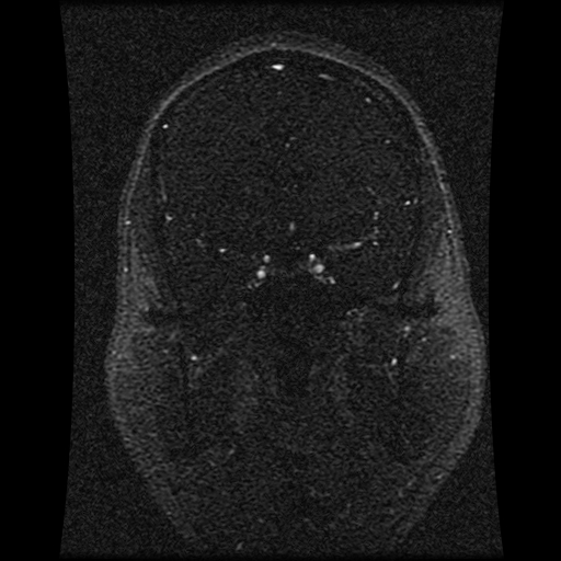 Carotid arterial dissection with acute cerebral infarction (Radiopaedia 26636-26784 MRV 110).jpg