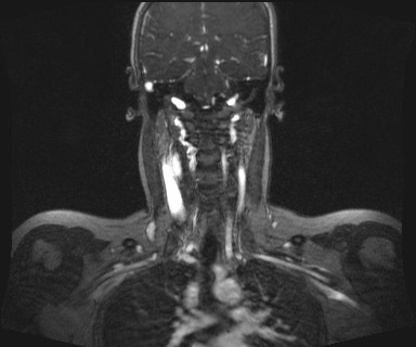 Carotid body tumor (Radiopaedia 12777-12912 MRA 42).jpg