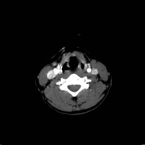 File:Carotid body tumor (Radiopaedia 39845-42300 B 18).jpg