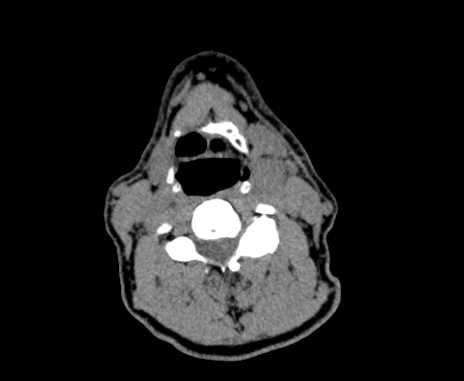 Carotid body tumor (Radiopaedia 61750-69757 Axial non-contrast 56).jpg