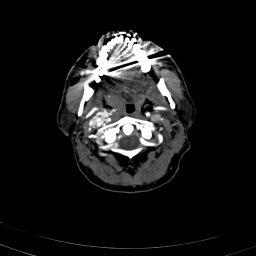 Carotid body tumor (Radiopaedia 83615-98727 A 37).jpg