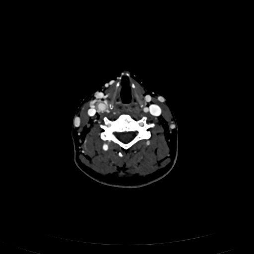 Carotid body tumor (Radiopaedia 83615-98727 D 76).jpg