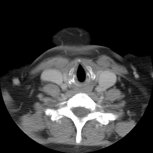 Carotid body tumor (paraganglioma) (Radiopaedia 38586-40729 A 25).jpg