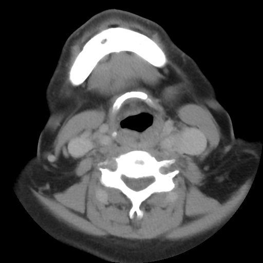 Carotid body tumor (paraganglioma) (Radiopaedia 38586-40729 A 57).jpg