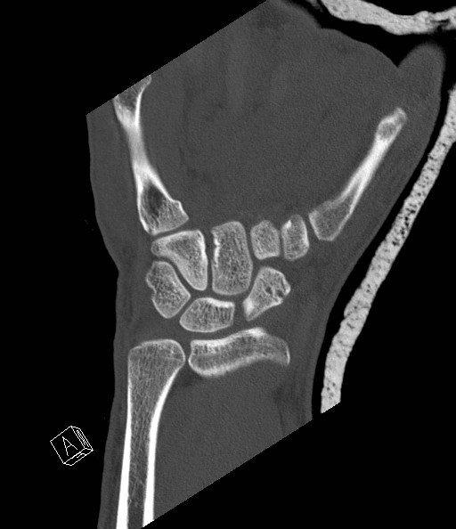 File:Carpal fractures (smart watch impaction) (Radiopaedia 55844-62430 Coronal bone window 14).jpg