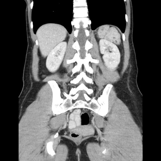 Castleman disease with fibrous pseudotumor in the abdomen (Radiopaedia 77296-89373 B 70).jpg