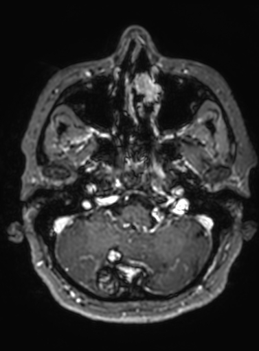 Cavernous hemangioma of the cerebellar falx (Radiopaedia 73025-83724 Axial T1 C+ 275).jpg