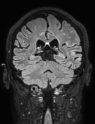 Cavernous hemangioma of the cerebellar falx (Radiopaedia 73025-83724 Coronal FLAIR 226).jpg