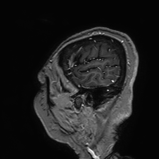 File:Cavernous hemangioma of the cerebellar falx (Radiopaedia 73025-83724 Sagittal T1 C+ 22).jpg