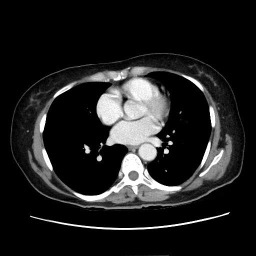 Cecal adenocarcinoma (Radiopaedia 75909-87331 A 5).jpg