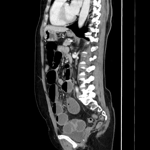 Cecal adenocarcinoma (Radiopaedia 75909-87331 C 43).jpg