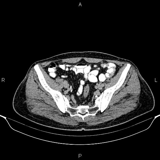 Cecal adenocarcinoma (Radiopaedia 85324-100916 Axial C+ delayed 80).jpg