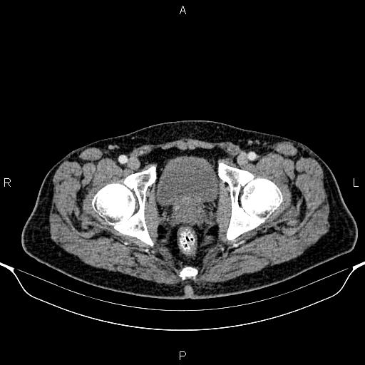 Cecal adenocarcinoma (Radiopaedia 85324-100916 B 96).jpg