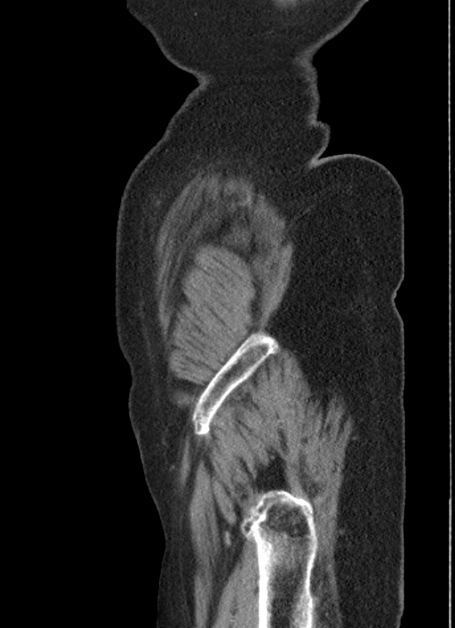 Cecal adenocarcinoma - surgical scar recurrence (Radiopaedia 79988-93264 D 61).jpg