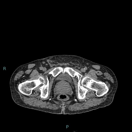 Cecal bascule (Radiopaedia 85770-101586 Axial non-contrast 105).jpg