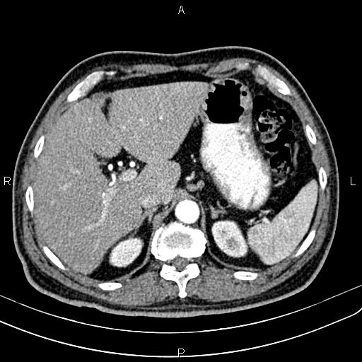 Cecal cancer with appendiceal mucocele (Radiopaedia 91080-108651 A 64).jpg