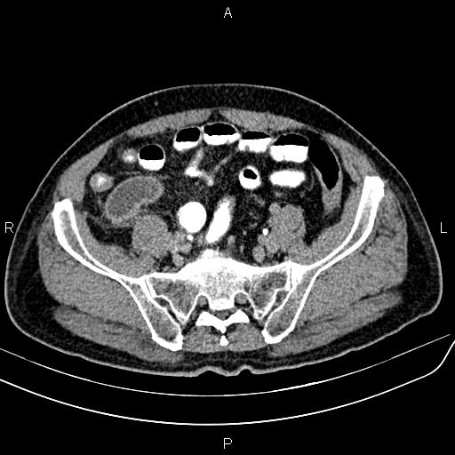 File:Cecal cancer with appendiceal mucocele (Radiopaedia 91080-108651 Axial C+ delayed 59).jpg