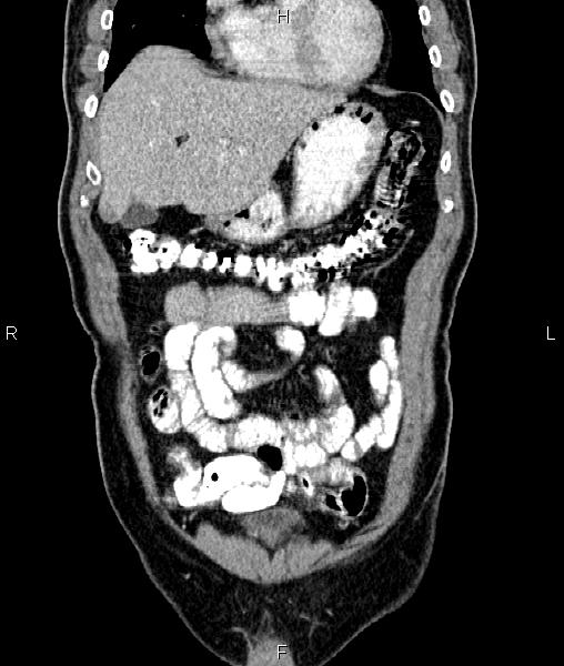 File:Cecal cancer with appendiceal mucocele (Radiopaedia 91080-108651 D 17).jpg