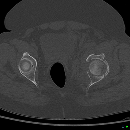 File:Central fracture-dislocation of the acetabulum (Radiopaedia 36578-38150 Axial bone window 56).jpg