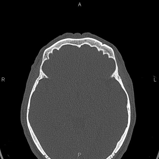 File:Central giant cell granuloma (Radiopaedia 83346-97761 Axial bone window 74).jpg