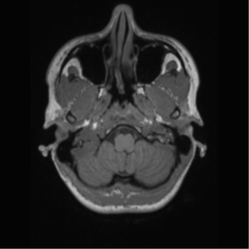 File:Central neurocytoma (Radiopaedia 37664-39557 Axial T1 9).png