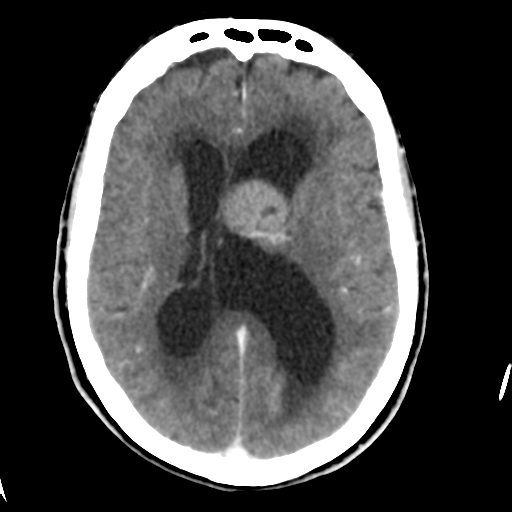 Central neurocytoma (Radiopaedia 65317-74346 Axial C+ delayed 28).png