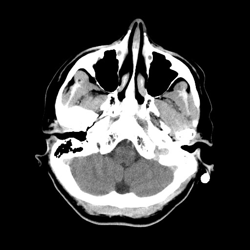 Central neurocytoma (Radiopaedia 68725-78432 Axial C+ 7).jpg