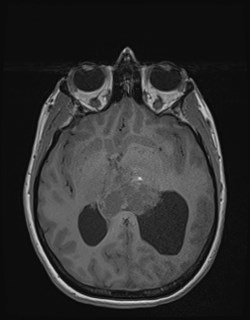 Central neurocytoma (Radiopaedia 84497-99872 Axial T1 101).jpg