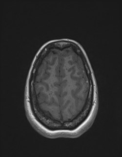 Central neurocytoma (Radiopaedia 84497-99872 Axial T1 162).jpg