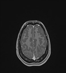 Central neurocytoma (Radiopaedia 84497-99872 Axial T1 C+ 129).jpg