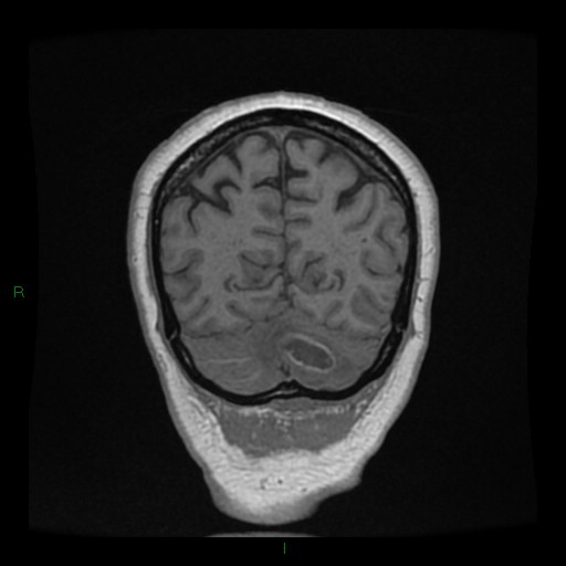 Cerebellar abscess (Radiopaedia 78135-90678 Coronal T1 C+ 135).jpg