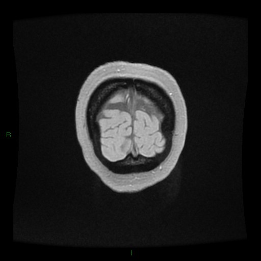 Cerebellar abscess (Radiopaedia 78135-90678 Coronal T1 C+ 165).jpg