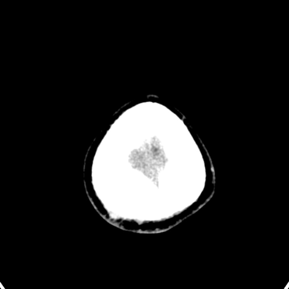 Cerebellar abscess secondary to mastoiditis (Radiopaedia 26284-26412 Axial non-contrast 150).jpg