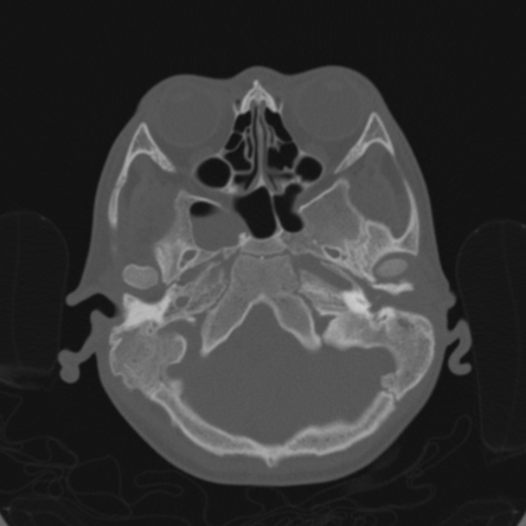 Cerebellar abscess secondary to mastoiditis (Radiopaedia 26284-26413 Axial bone window 39).jpg