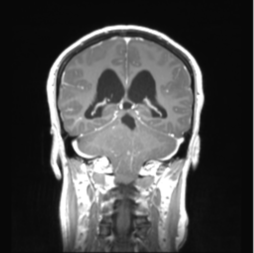 Cerebellar ependymoma complicated by post-operative subdural hematoma (Radiopaedia 83322-97736 Coronal T1 C+ 36).png
