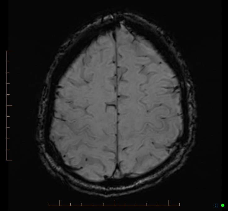 Cerebellar gangliocytoma (Radiopaedia 65377-74422 Axial SWI 48).jpg